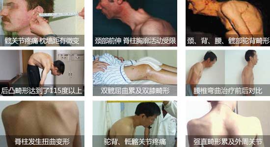貴陽強(qiáng)直醫(yī)院強(qiáng)直性脊柱炎引起脊椎彎曲、關(guān)節(jié)疼痛.jpg